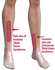 shin splints.jpg