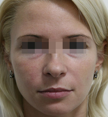 botox_s0801.jpg